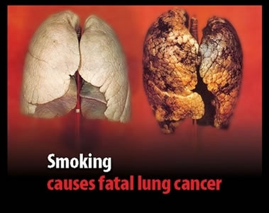 smokers-lungs1.jpg